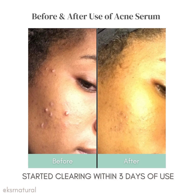 Acne Serum (Acne Out)